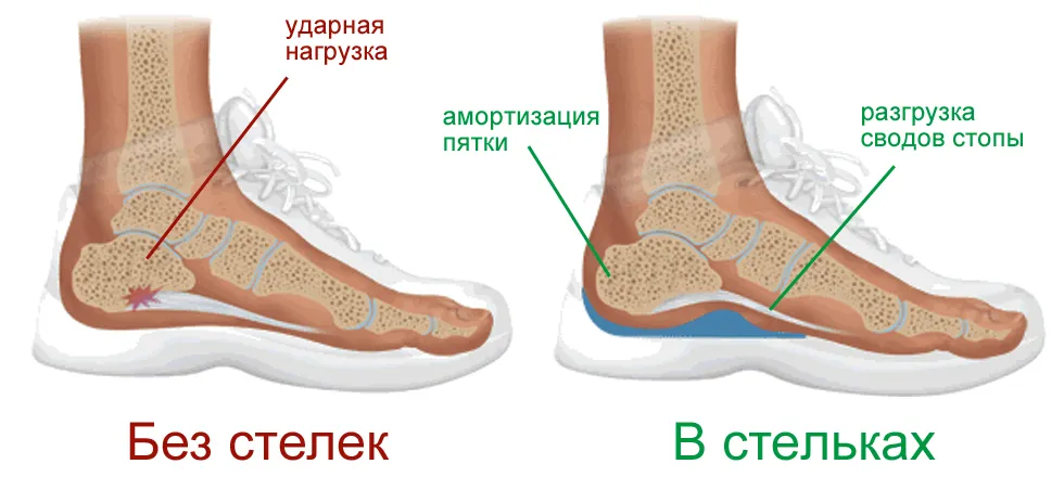 Ортопедические стельки при болях в позвоночнике 107 — изображение 5