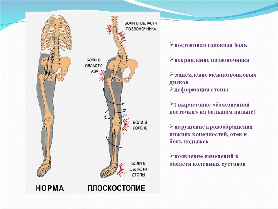 Ортопедические стельки при болях в позвоночнике 107 7